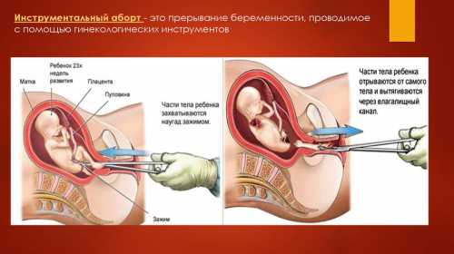 Какие есть виды абортов